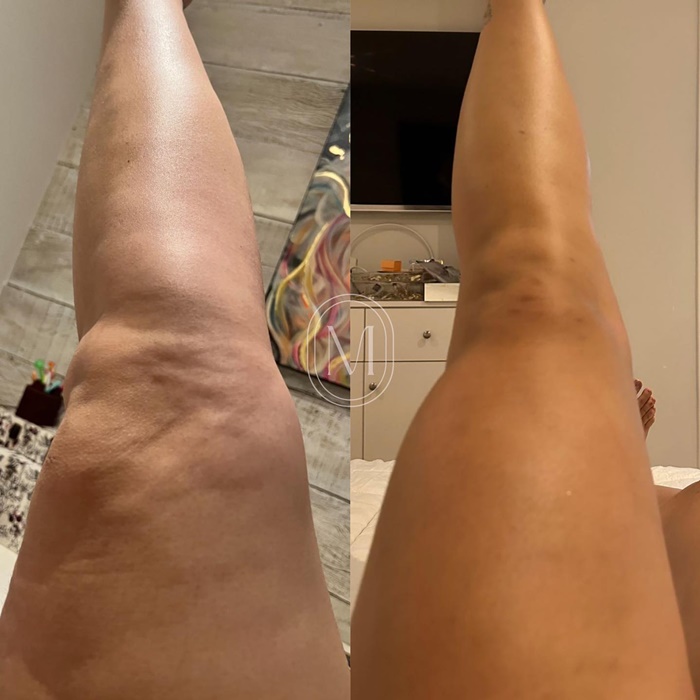 lipedema-antes-e-depois03.jpg