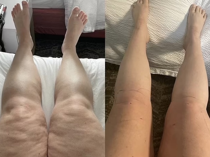 lipedema-antes-e-depois10.jpg
